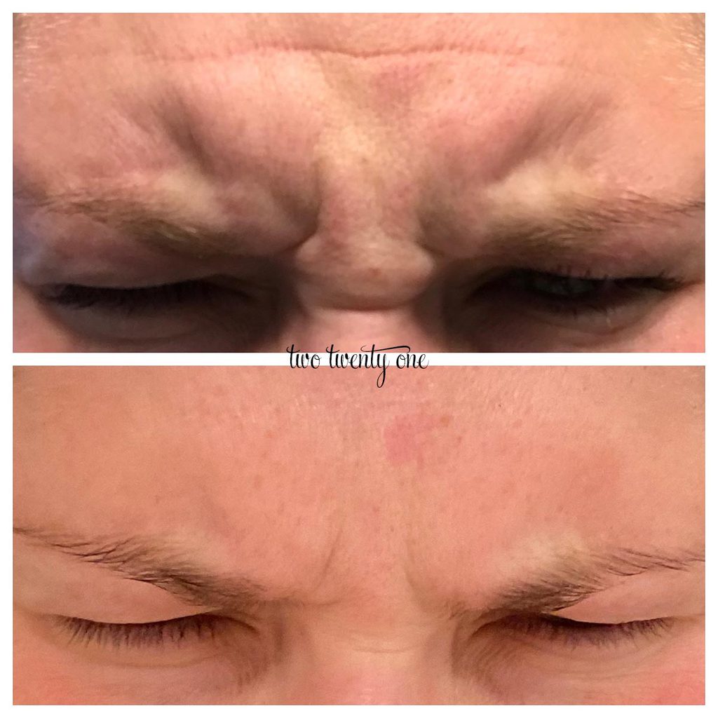 botox 11s before and after