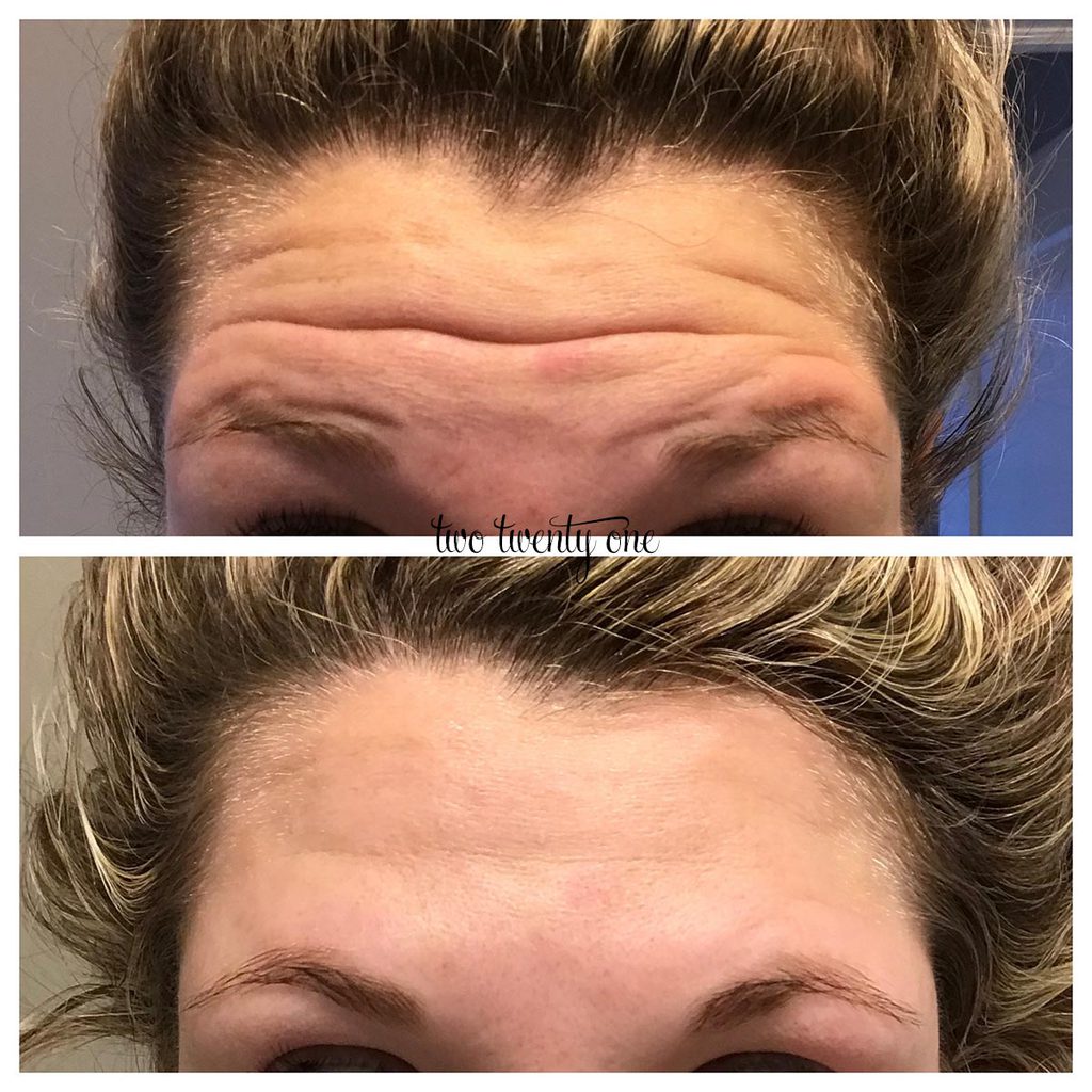 botox before and after