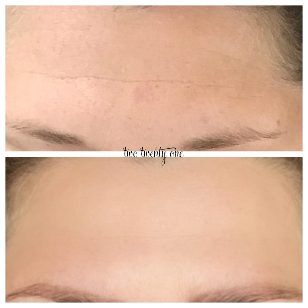 botox forehead before and after